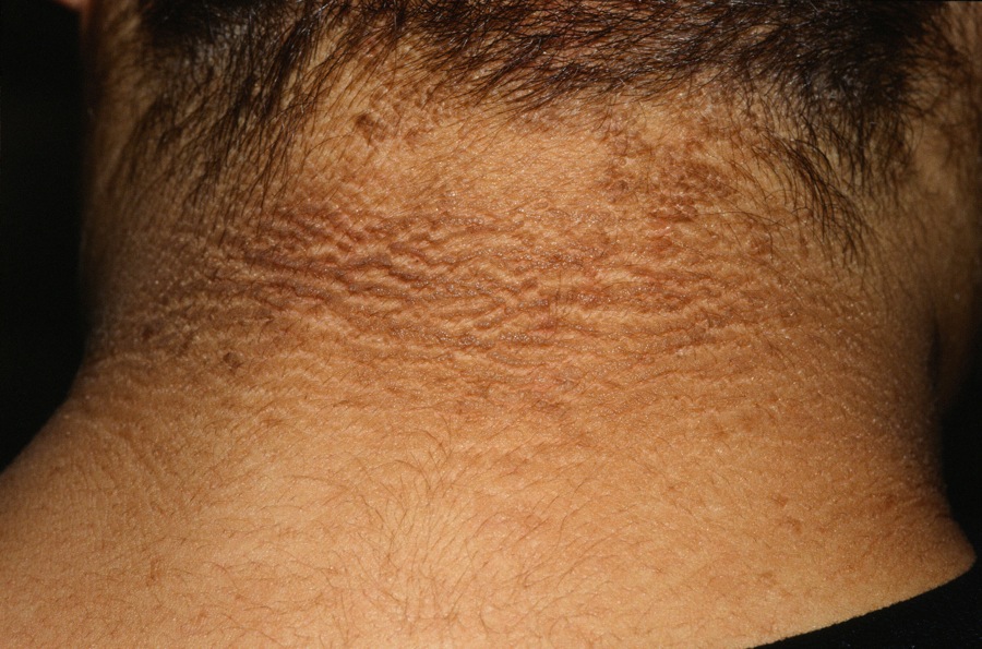 acanthosis nigricans