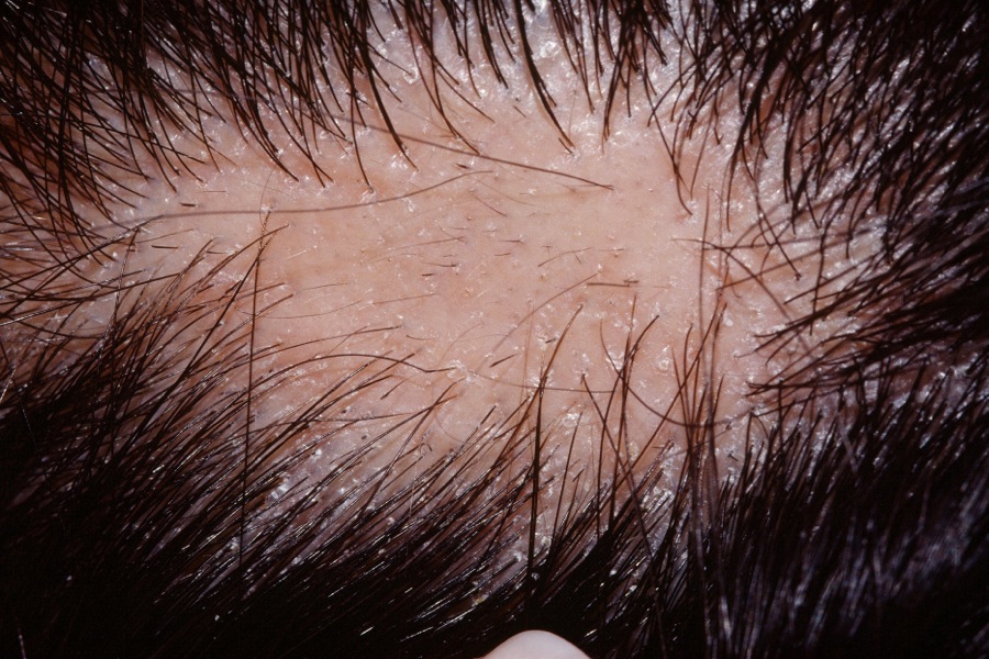 Alopecia areata