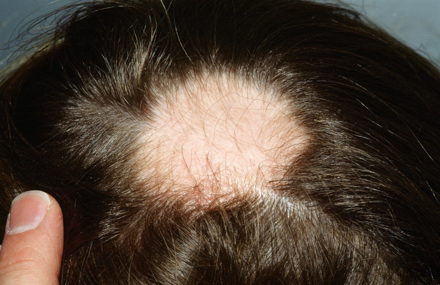 Alopecia areata