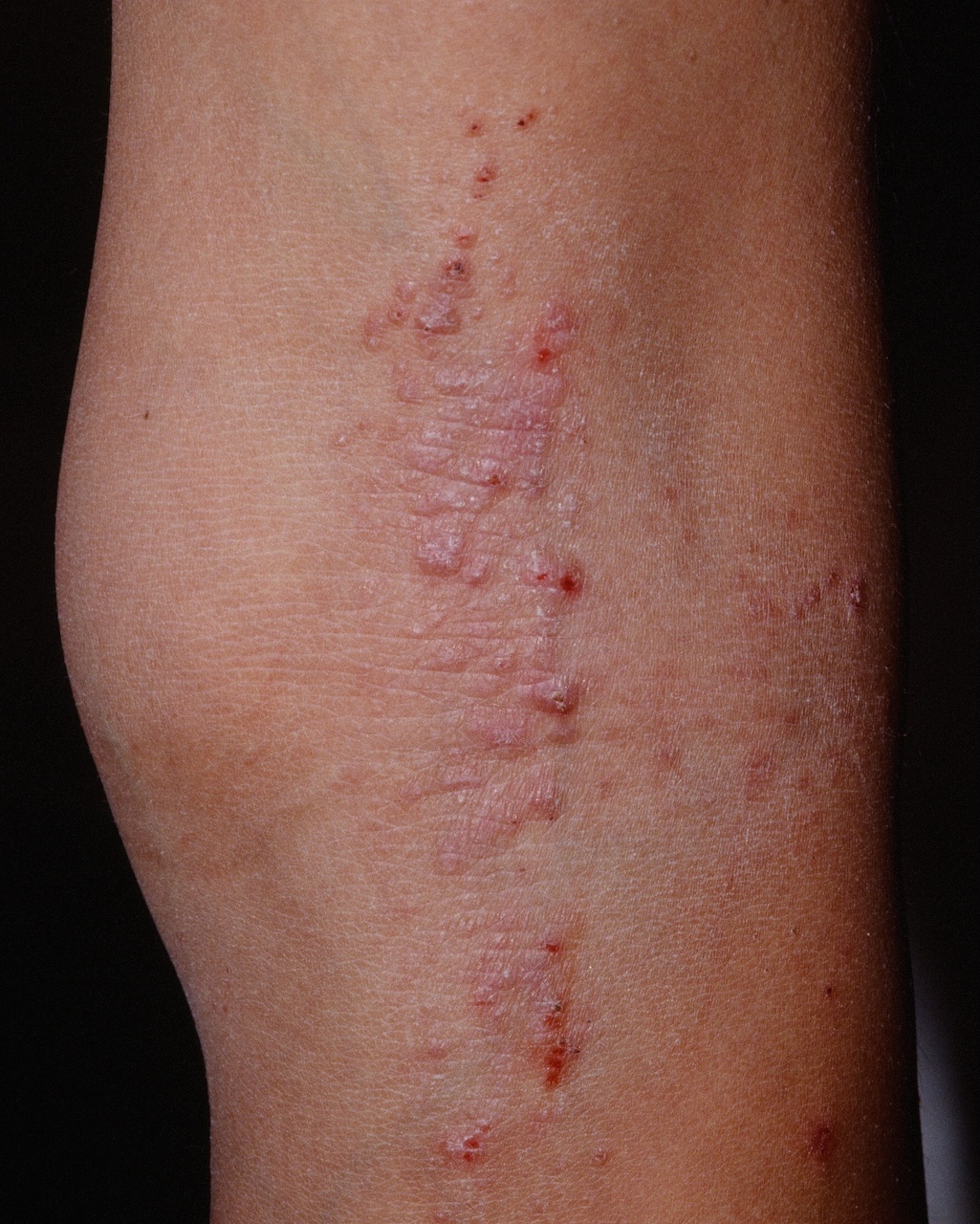 Atopic Dermatitis