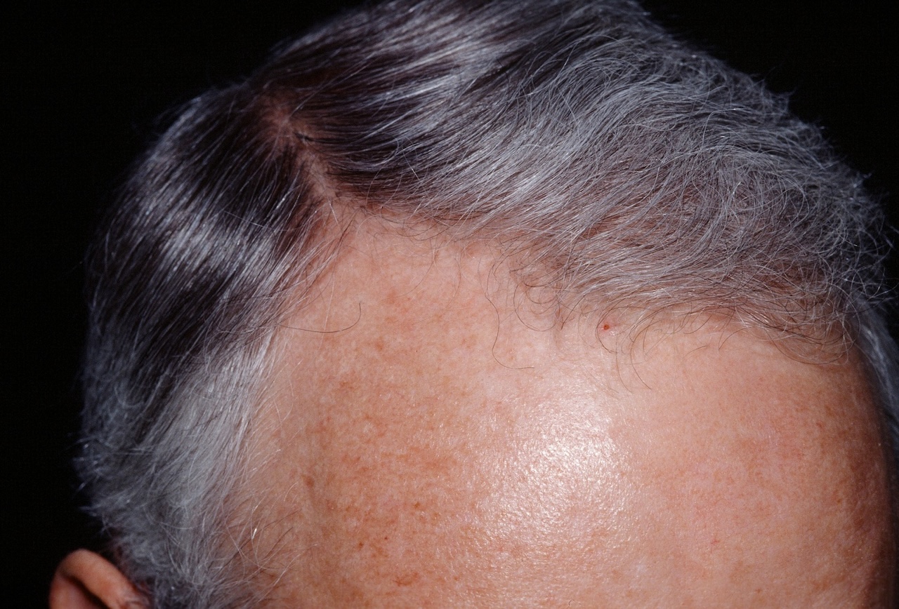 Androgenetic Alopecia in a Man