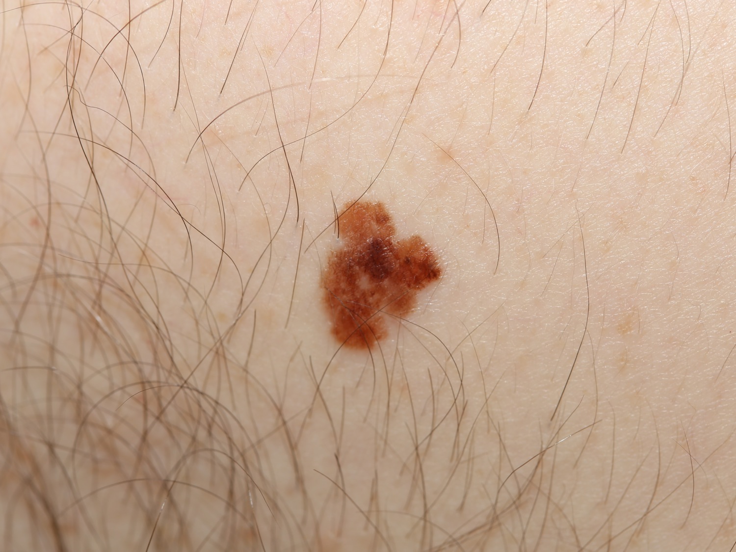 A melanoma with notched borders and multiple colors