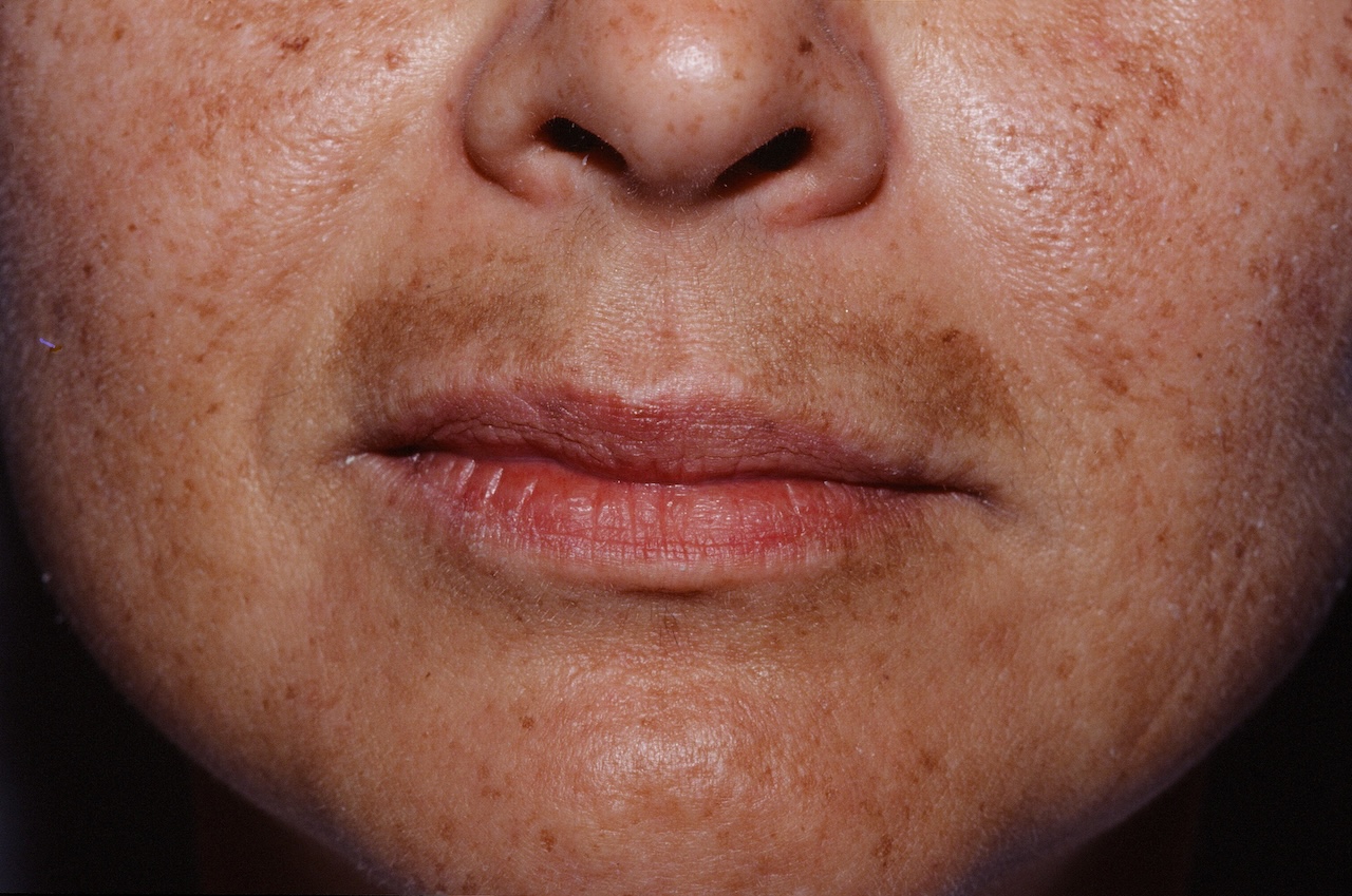 Melasma on the upper lip