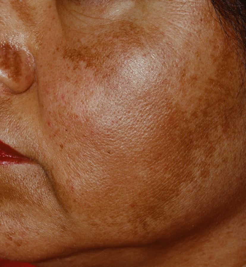 Melasma of the cheek in a Hispanic woman