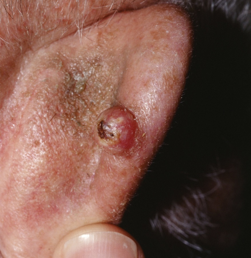 squamous cell carcinoma on the ear