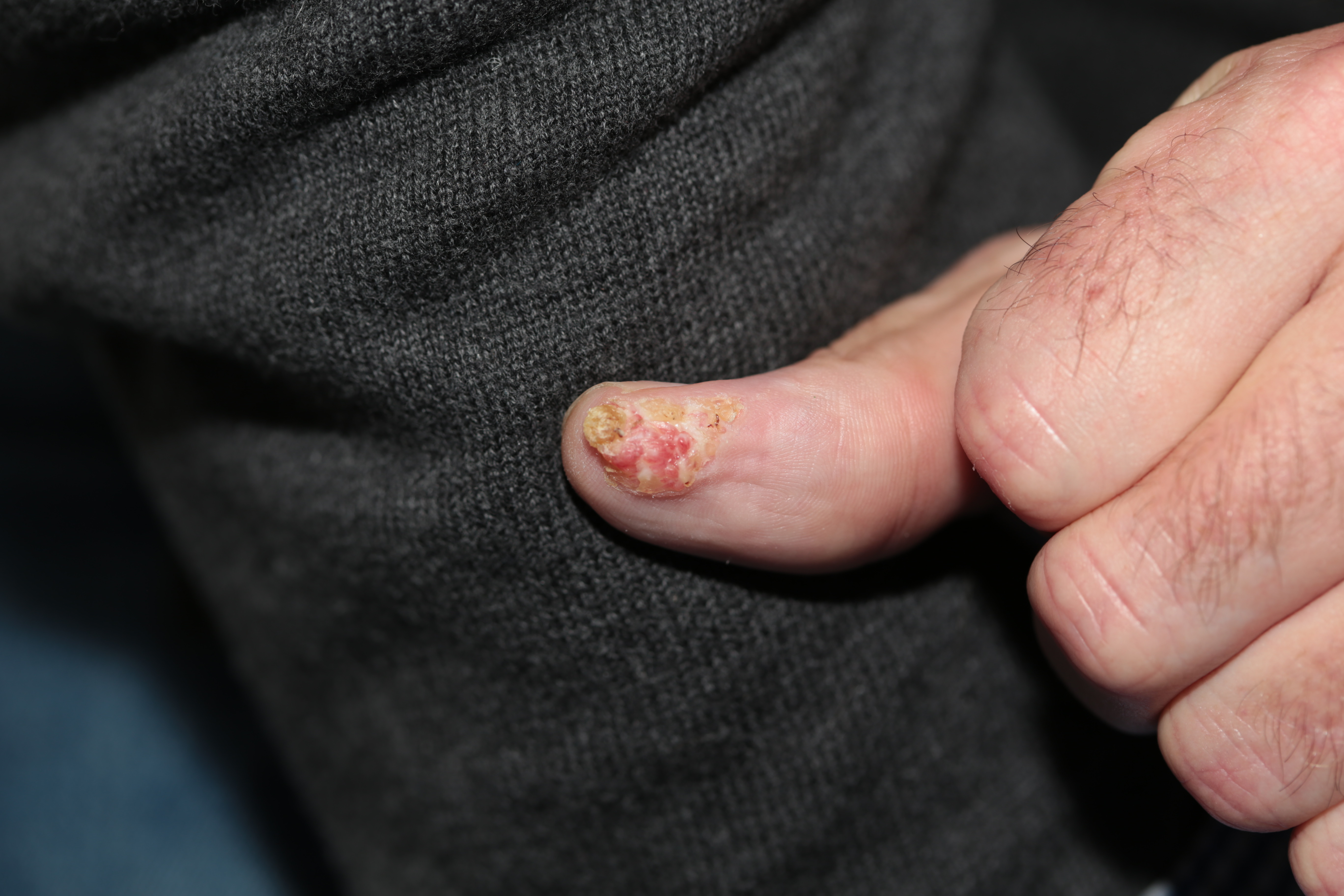 squamous cell carcinoma on the finger