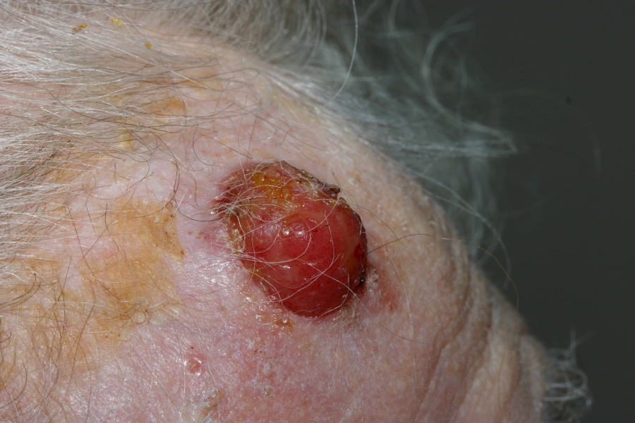 squamous cell carcinoma on the forehead