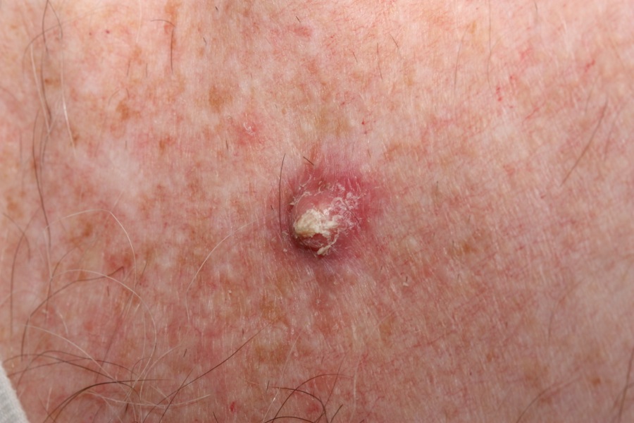 squamous cell carcinoma on the