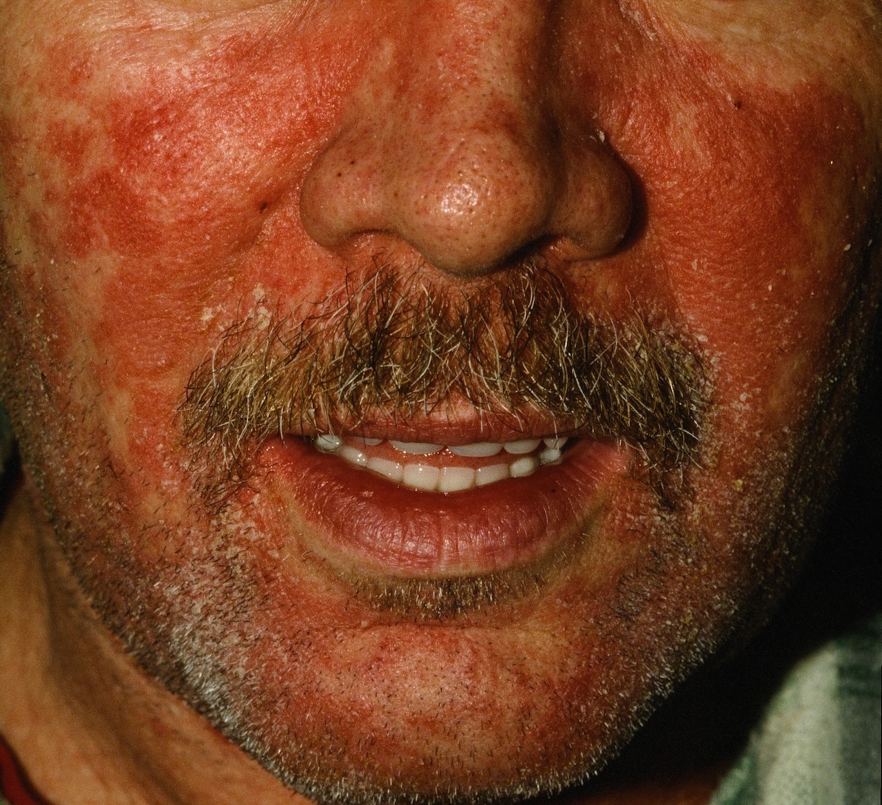 Seborrheic Dermatitis