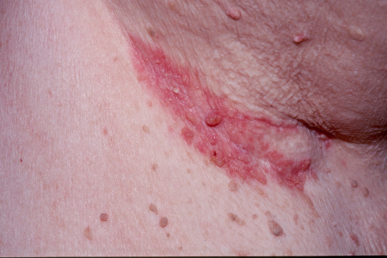 Seborrheic Dermatitis