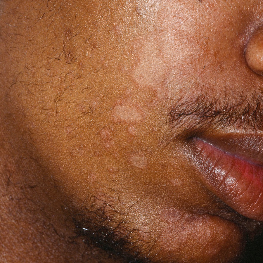 Seborrheic Dermatitis