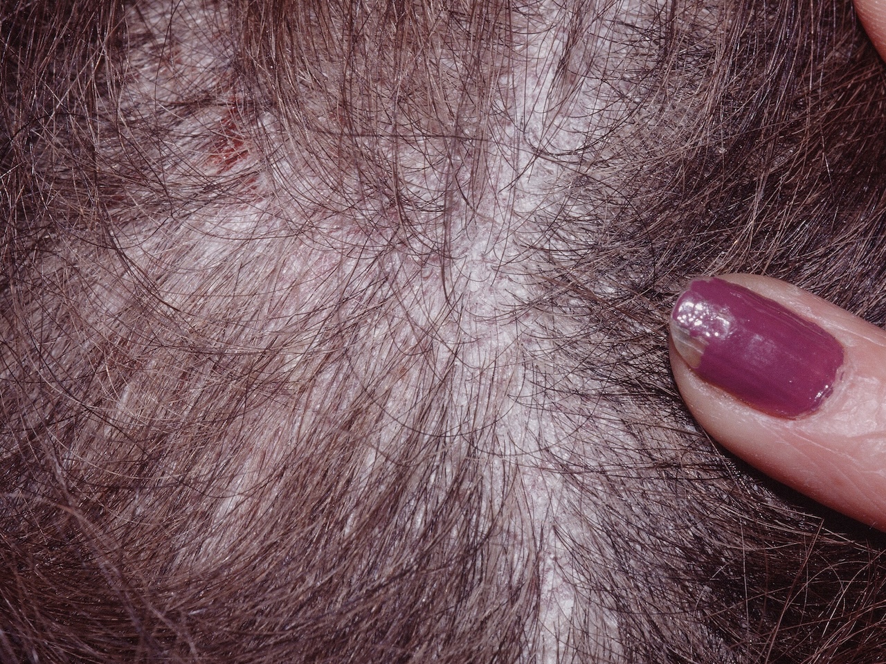 Seborrheic Dermatitis