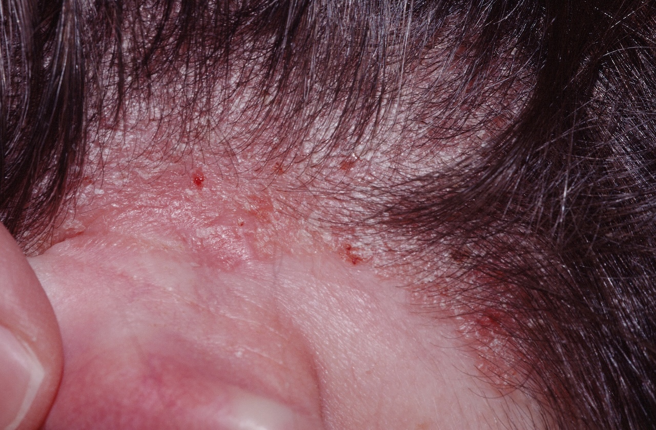 Seborrheic Dermatitis