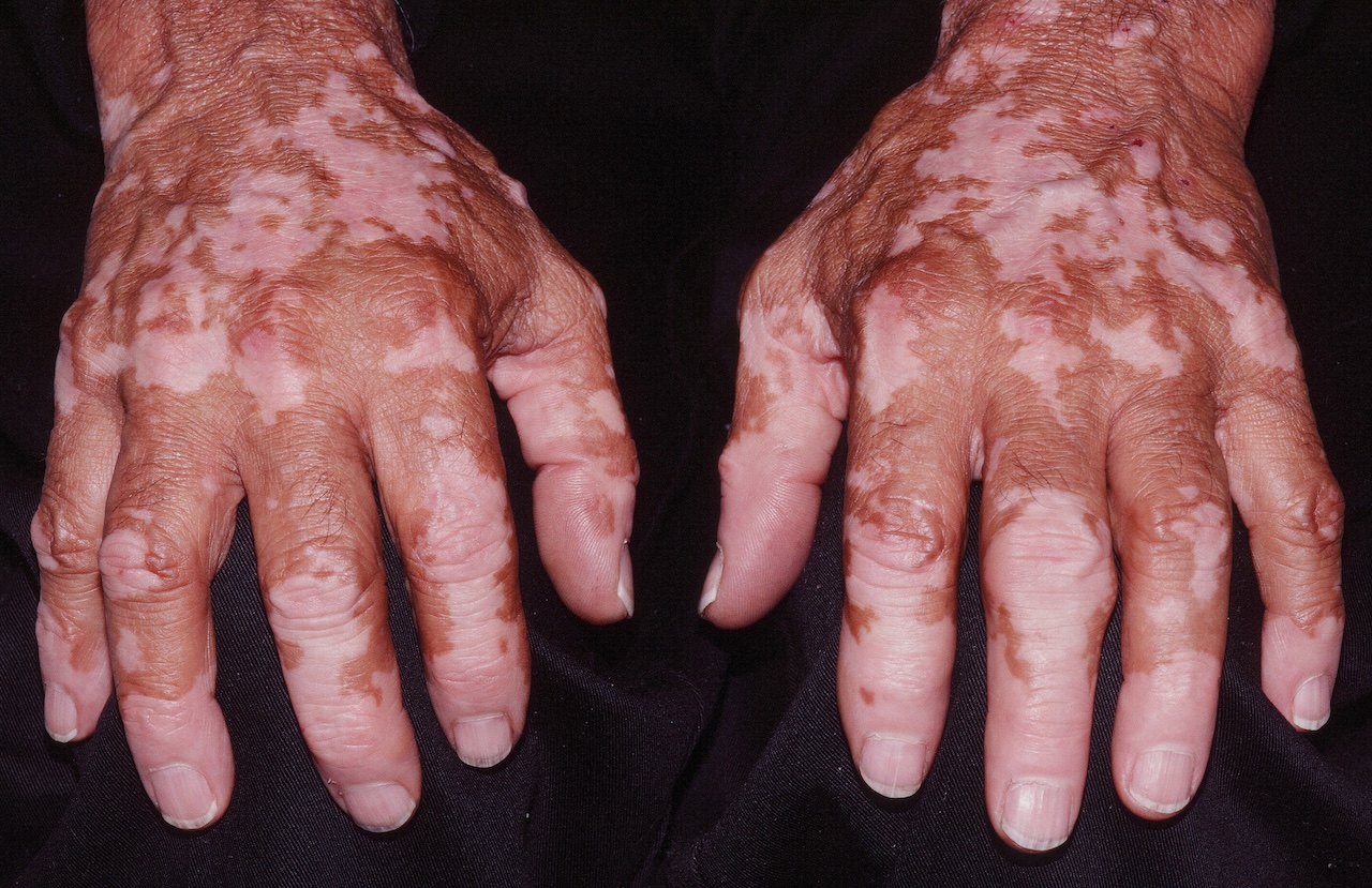 Vitiligo on the hands