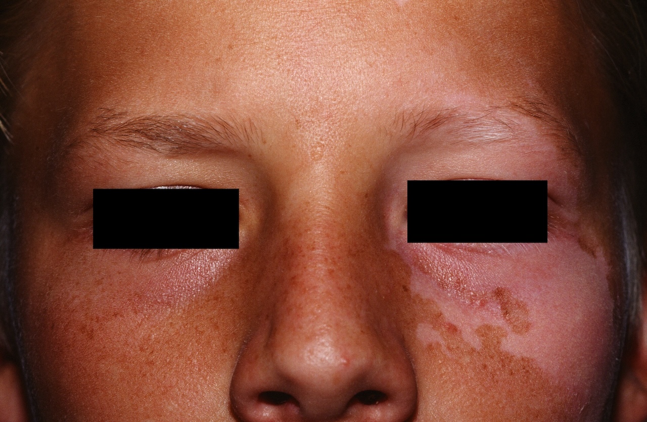 Segmental Vitiligo